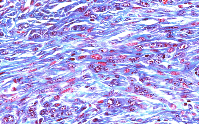 Masson's trichrome staining of non-small cell lung cancer tissue sample
